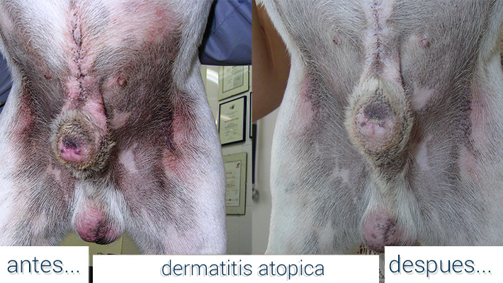 dermatitis_atopica
